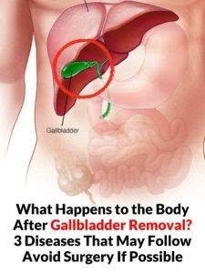 What Happens to Your Body After Gallbladder Removal? 3 Possible Health Problems to Know About 834802973_122203243958787195_6658025818625605451_n