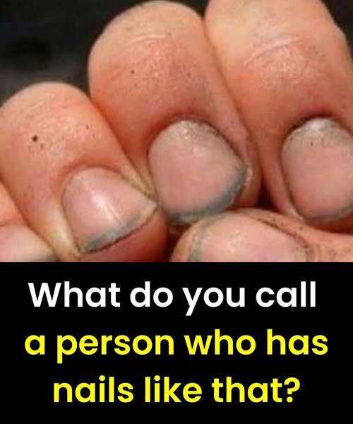 What Do You Call a Person With Blue or Gray Fingernails? What Your Nails May Reveal 836085048_122129164605334159_5152357102090382807_n