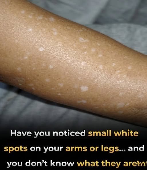 Small White Spots on Arms and Legs: What Are They and Should You Worry? 840951597_2194026351506167_4160369960603028461_n