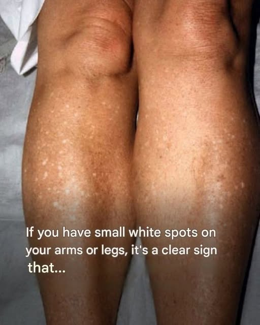 Why Do White Spots Appear on Your Skin in Summer? A Dermatologist Explains the Causes and Treatments image
