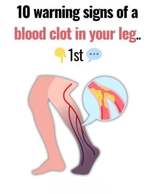 10 Warning Signs of a Blood Clot in the Leg You Should Know image
