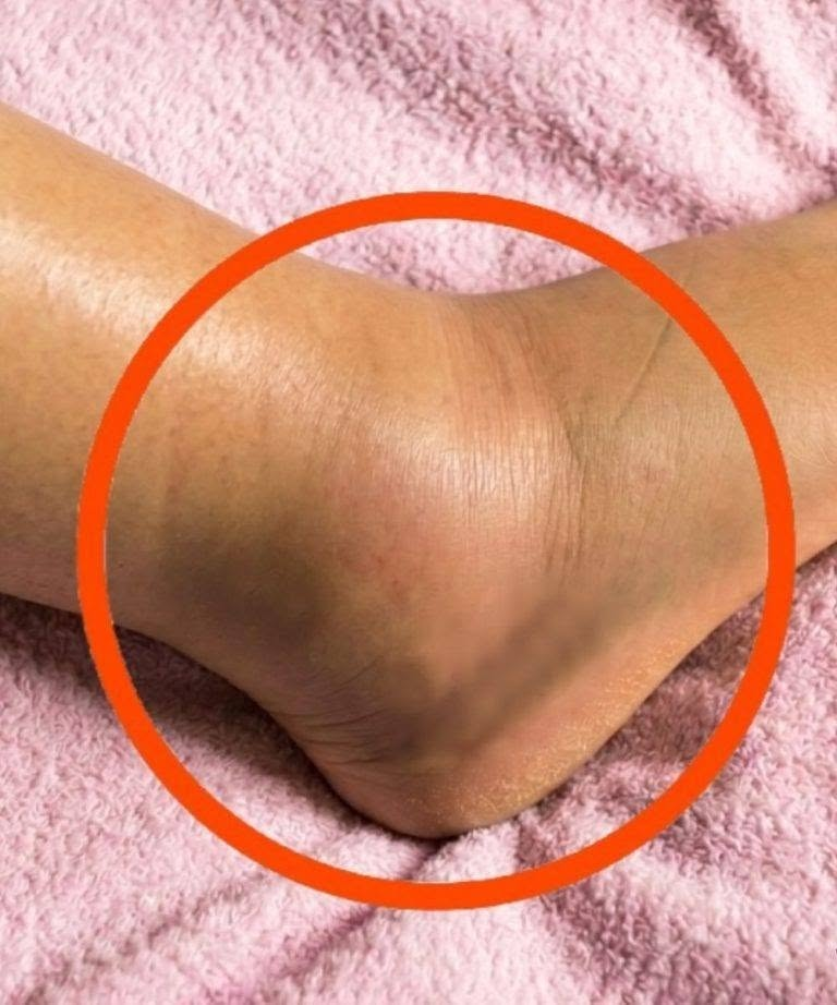 Swollen Legs and Ankles: What Your Body May Be Telling You image