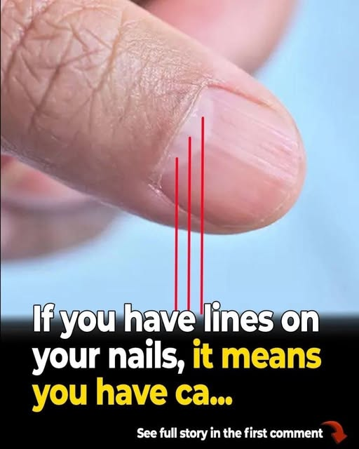 What Do Lines on Your Fingernails Mean? The Nail Changes You Should Know About image