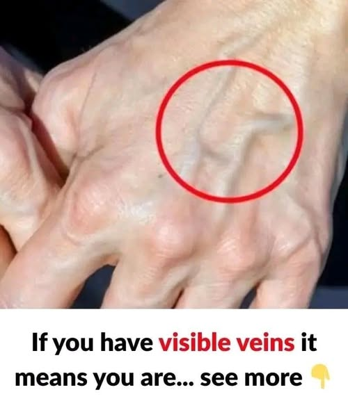 If Your Veins Are Visible in Your Hands, What Does It Mean? image