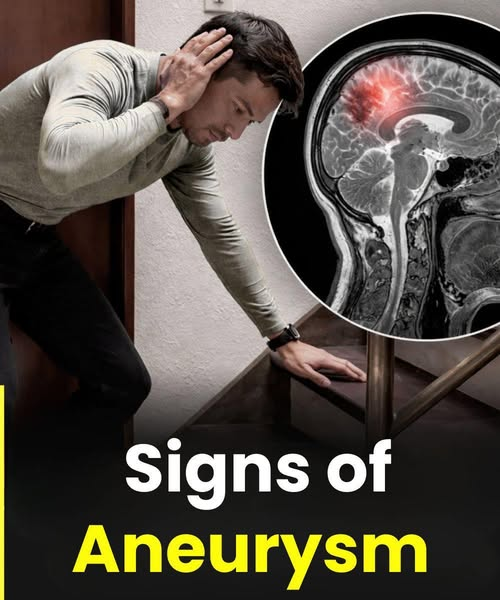 Warning Signs of an Aneurysm in Men: Symptoms You Should Never Ignore image
