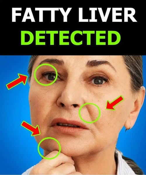 Fatty Liver Disease: The Hidden Signs You Should Know About image
